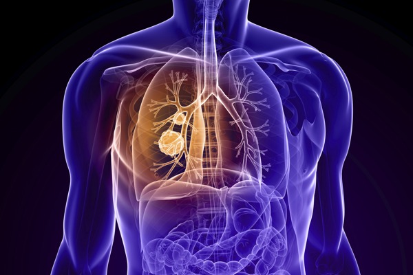 Lung Cancer Detection Using Low-Dose CT