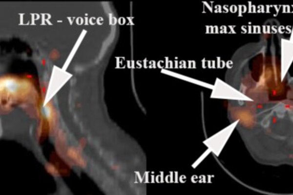 Scintigraphic Reflux Studies