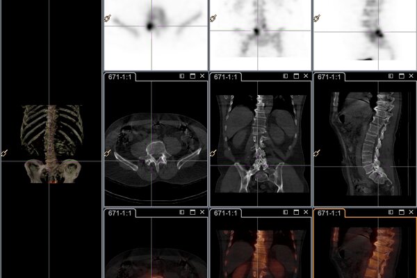 Pain Management & Nuclear Medicine SPECT/CT Imaging