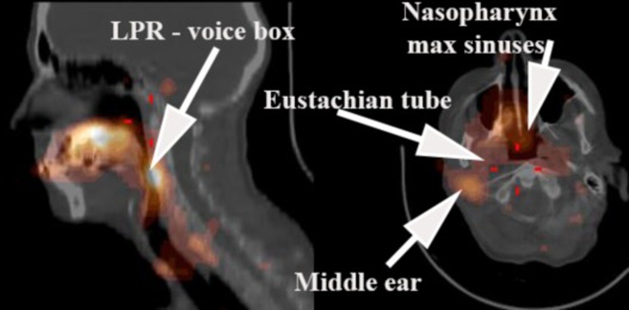 Scintigraphic Reflux Studies CitiScan Radiology Brisbane CBD scintigraphic-reflux-studies-citiscan-radiology-brisbane-cbd