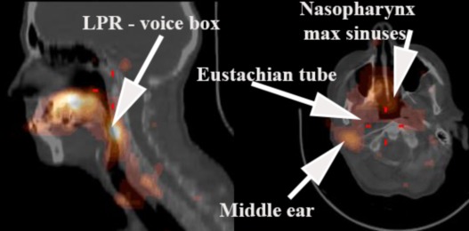 CitiScan Radiology Image - GERD contamination identified throughout LPR, nasopharynx and eustachian tubes